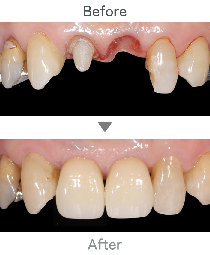 前歯のインプラント