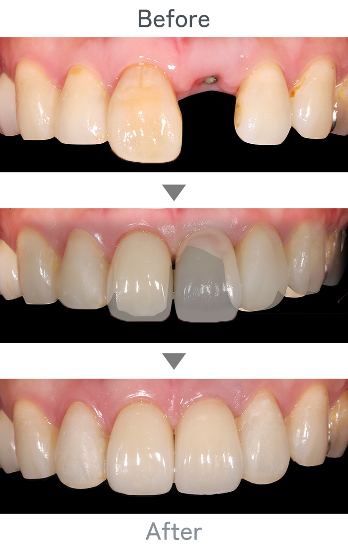 前歯のインプラント