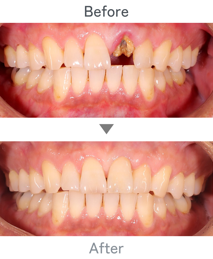 前歯のインプラント