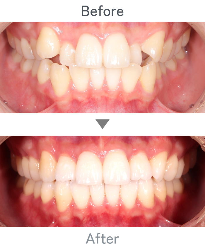 インビザライン