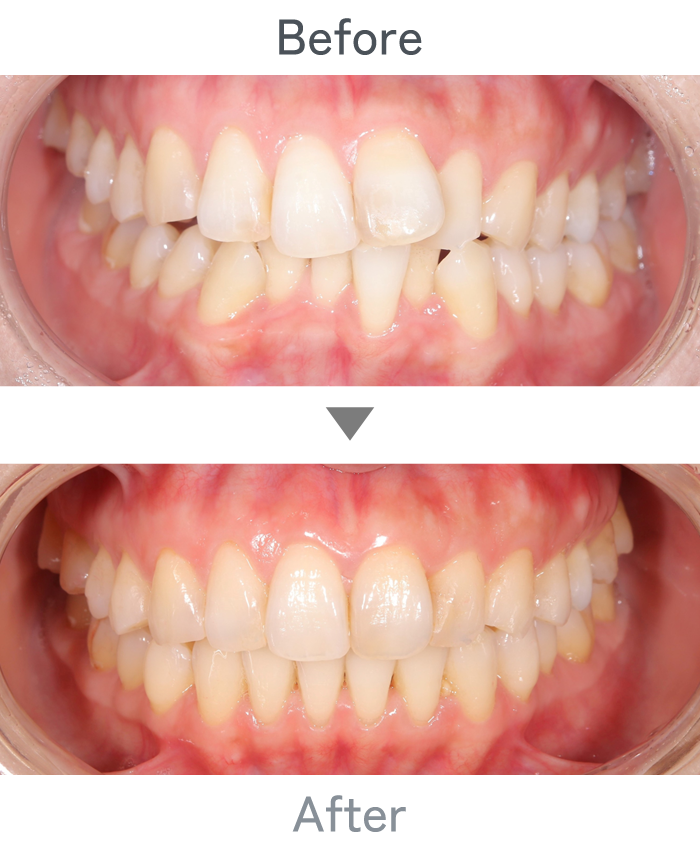 インビザライン