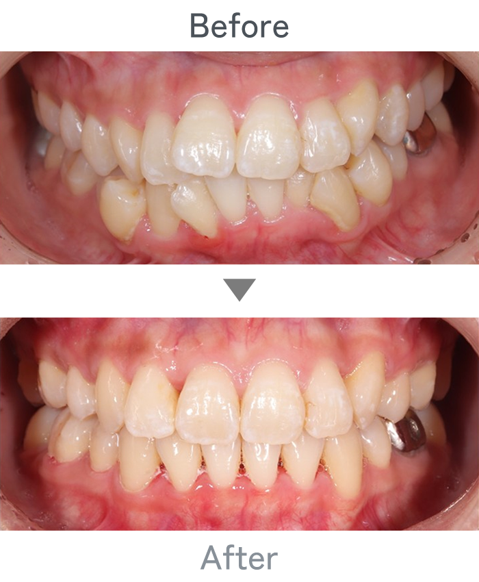 インビザライン