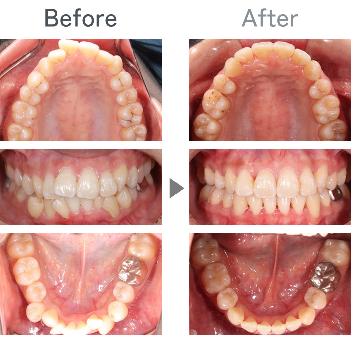 インビザライン