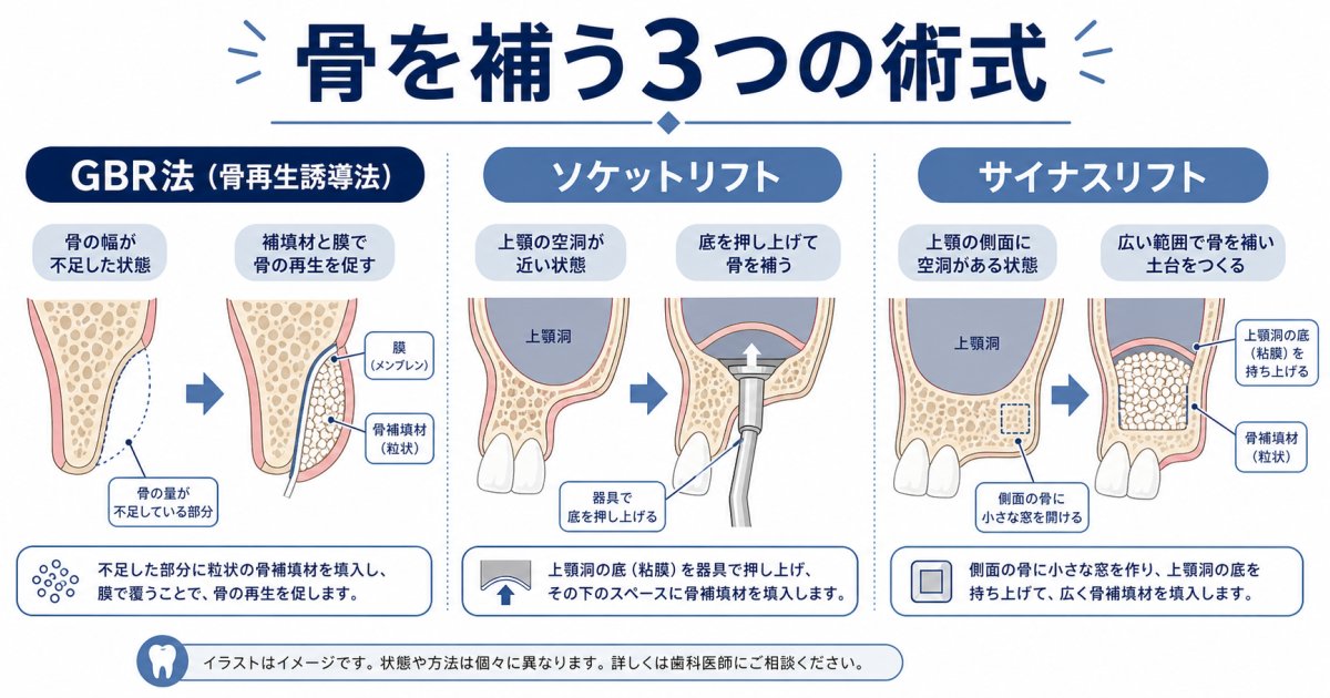 上顎や骨不足に対応する骨造成治療(GBR法・サイナスリフト・ソケットリフト)